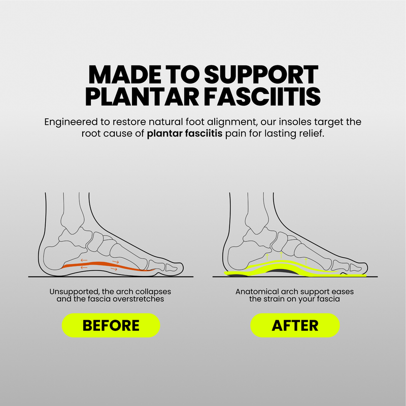 The Windlass Mechanism: The Physics That Explains Your Heel Pain